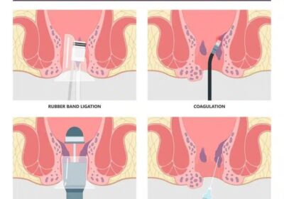 hemorrhoids-surgery