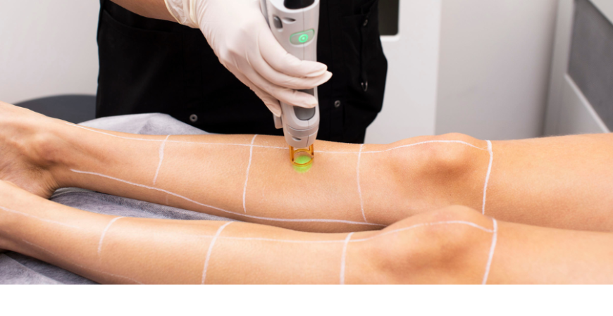 Laser Hair Removal in Multan – Safe & Effective Laser Treatment for Hair Removal at Dot Clinics