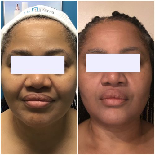 SQT Bio Microneedling in Rolesville NC | Advanced Skin Rejuvenation