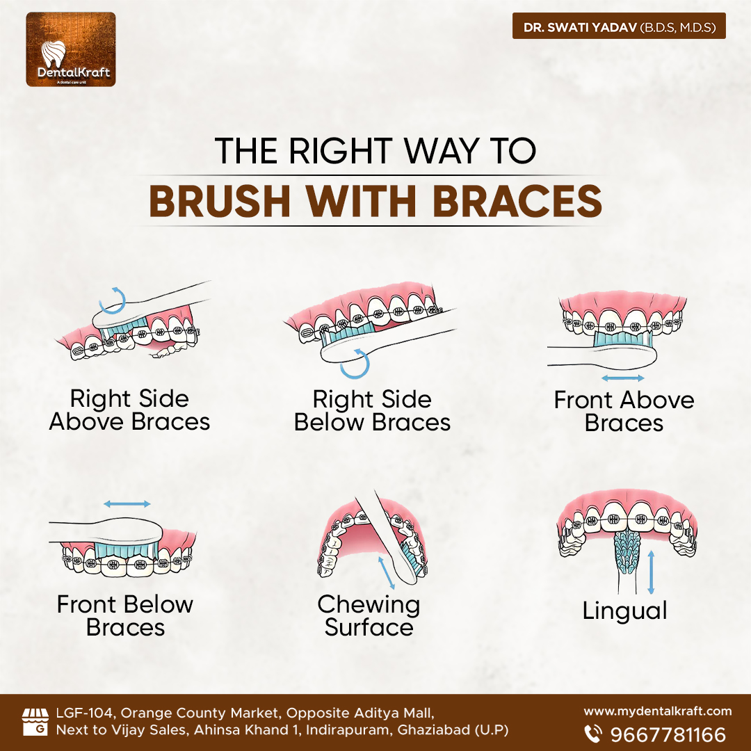 Best Braces treatment for teeth straightening in Indirapuram