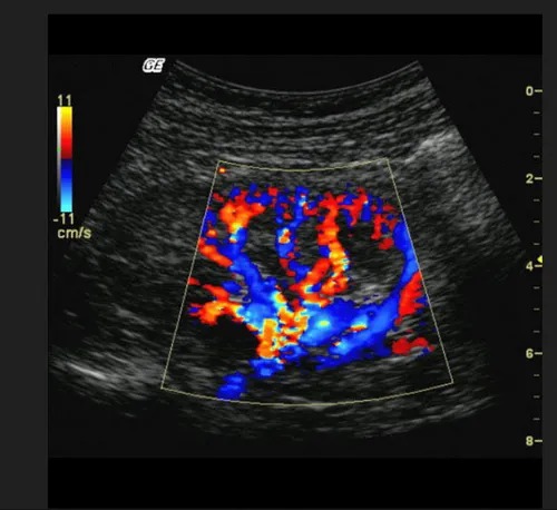 Color Doppler in South Delhi – SVMC Affordable Price