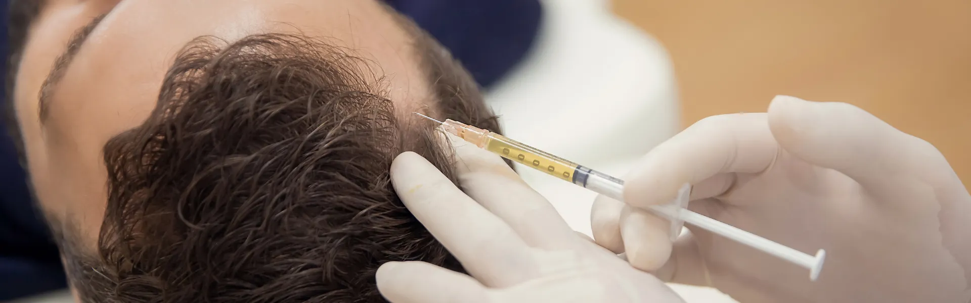 PRP Hair Treatment in Delhi – Advanced Solution for Hair Regrowth