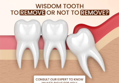 Best-Dentist-for-Tooth-Extraction-in-Indirapuram-8