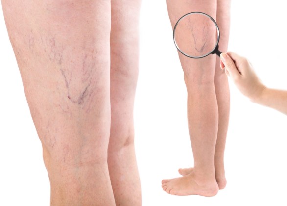 Sclerotherapy Clinic Etobicoke