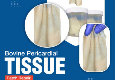 Bovine-Pericardial-Tissue-Patch-Repair