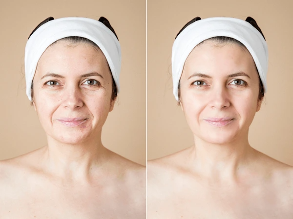 Anti Aging Treatment in Raleigh NC – Look Younger Today