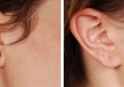 Earlobe-treatment-in-Delhi-Resplendent-Cosmetics
