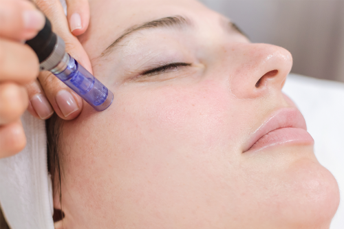 Professional Microneedling Surrey BC for Glowing Skin