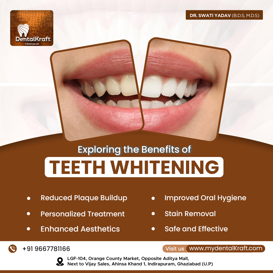 Teeth whitening treatment in Indirapuram for brighter smiles