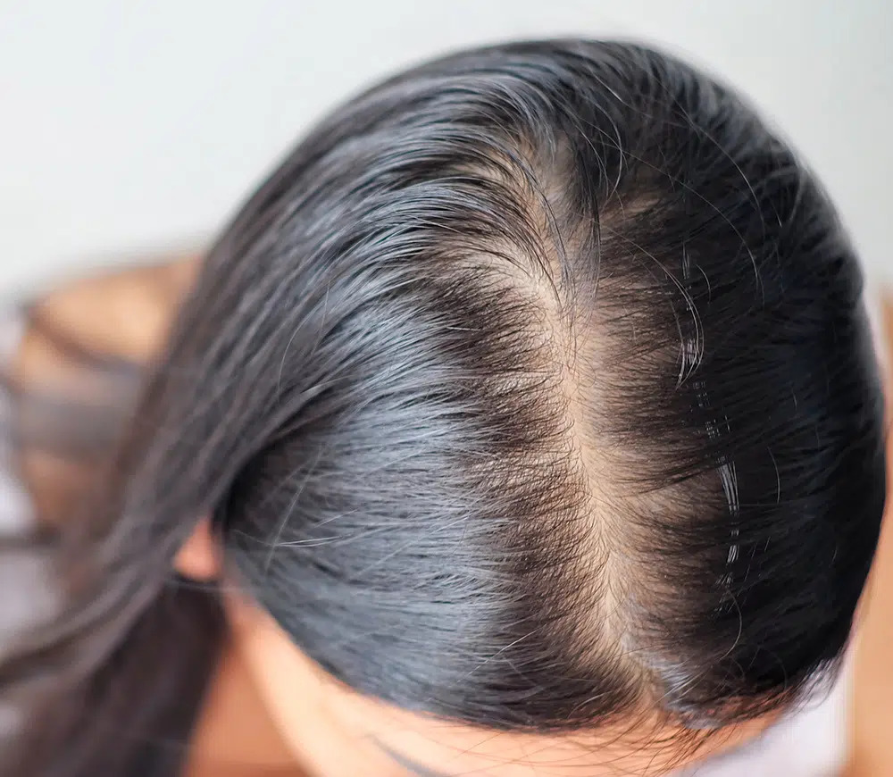 Specialized Alopecia Areata Treatment in Noida | Herbal & Holistic Care
